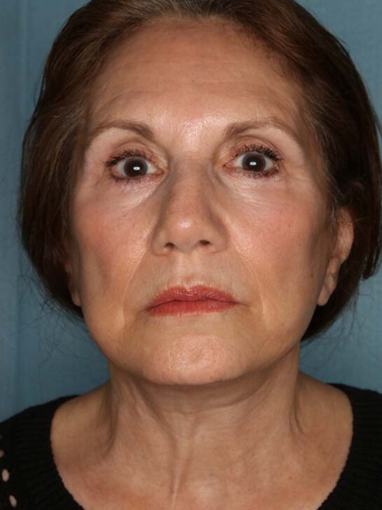 Case # 21 after photo