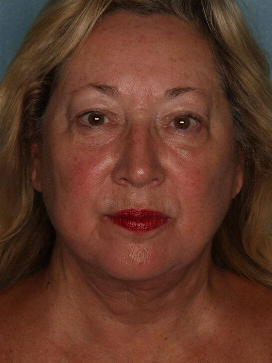 Case # 22 after photo