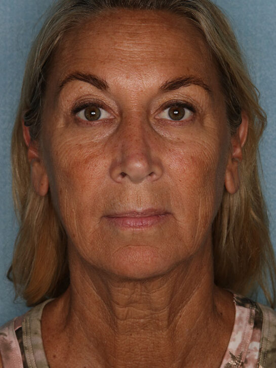 Case # 23 before photo