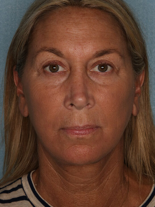 Case # 23 after photo