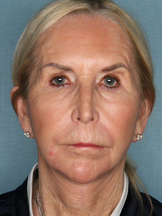 Case # 24 after photo