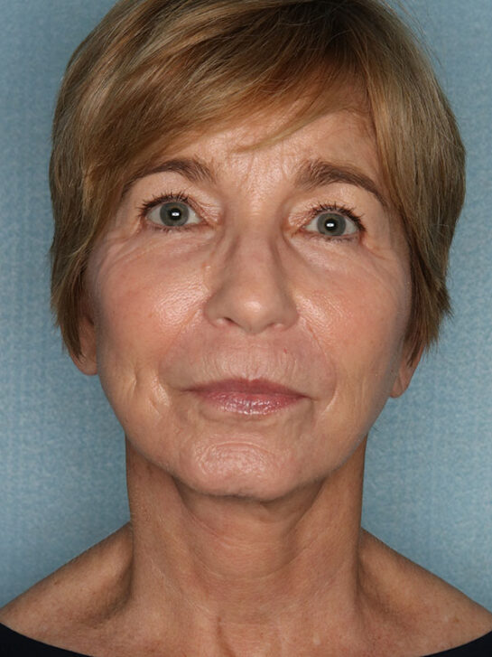 Case # 27 after photo