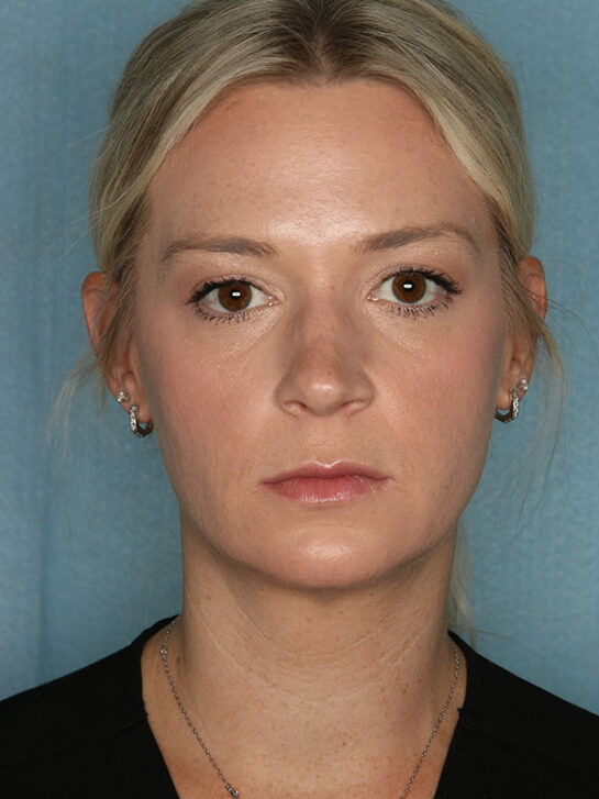 Case # 1 after photo