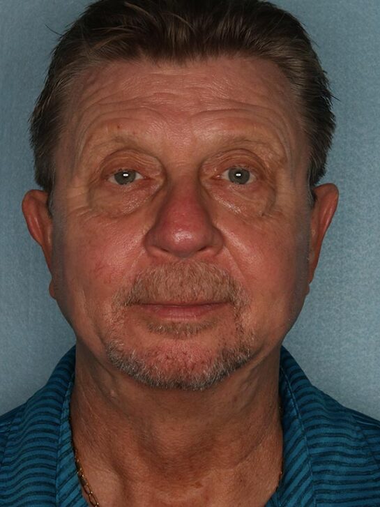 Case # 2 after photo