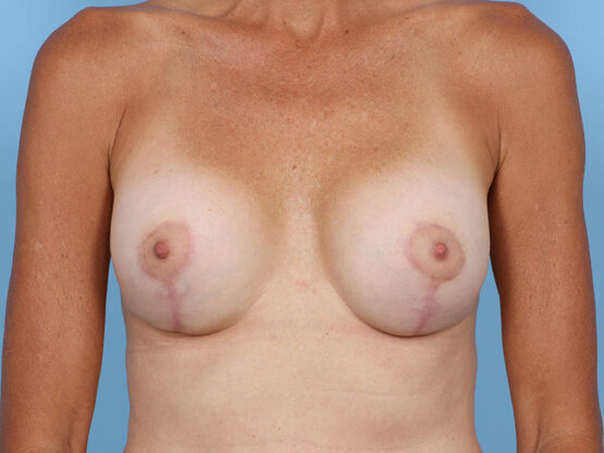 Case # 25 after photo