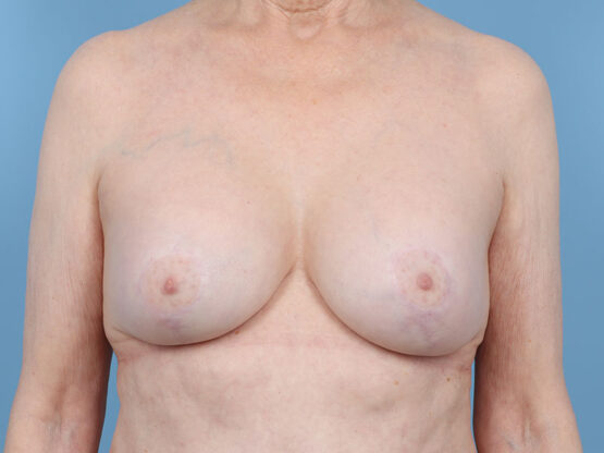 Case # 26 after photo