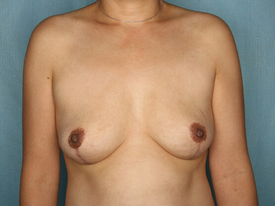 Case # 3 after photo