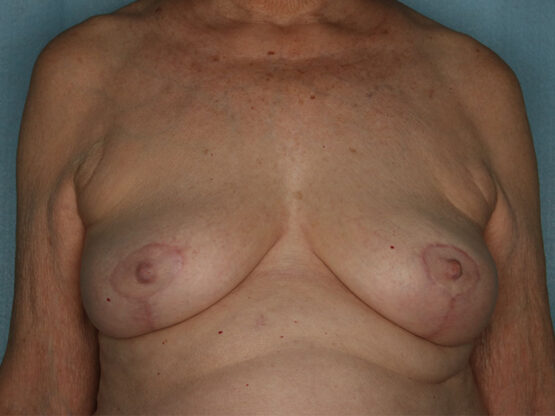 Case # 6 after photo