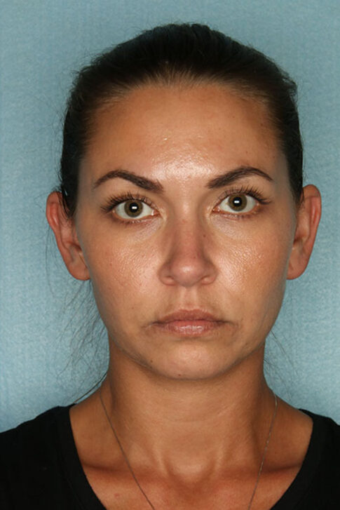 Case # 1 after photo