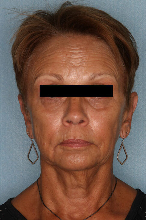 Case # 2 before photo