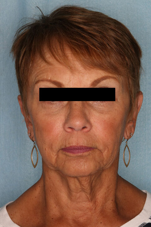 Case # 2 after photo