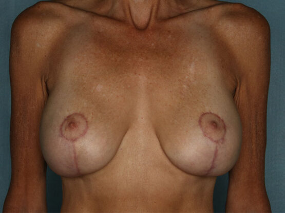 Case # 17 after photo