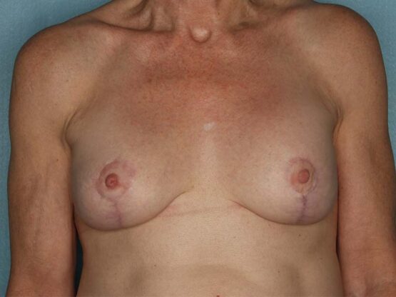 Case # 24 after photo