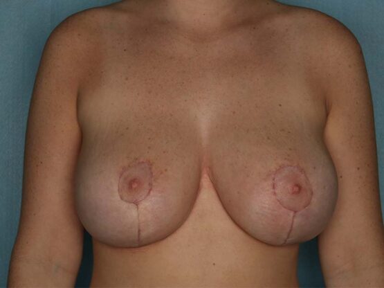 Case # 25 after photo