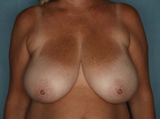 Case # 25 before photo