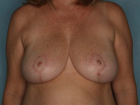 Case # 25 after photo