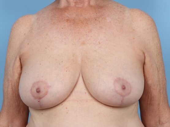 Case # 33 after photo