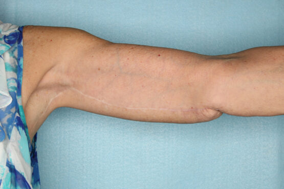 Case # 1 after photo