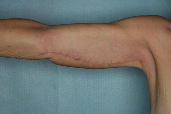 Case # 2 after photo