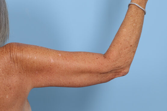 Case # 4 after photo