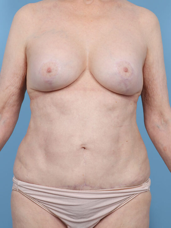 Case # 3 after photo