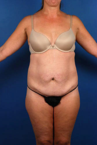 Case # 1 before photo