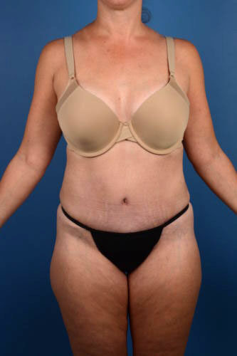 Case # 1 after photo