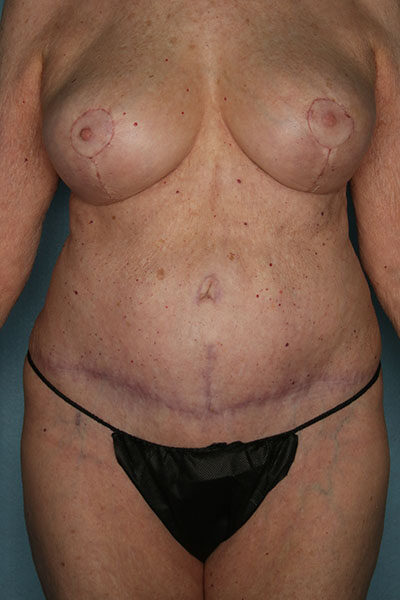 Case # 6 after photo