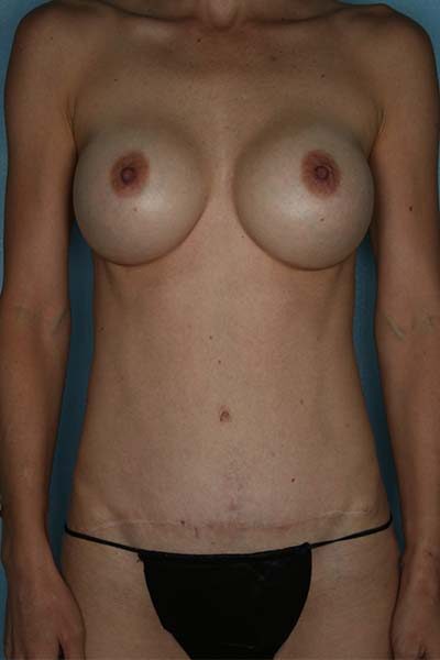 Case # 10 after photo