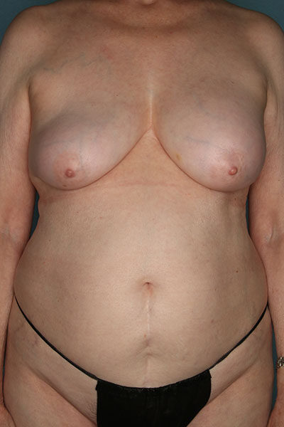 Case # 15 before photo