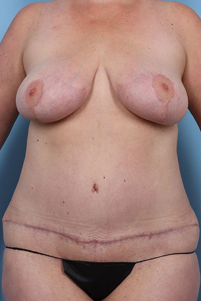 Case # 17 after photo