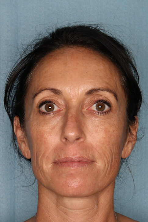 Case # 3 after photo