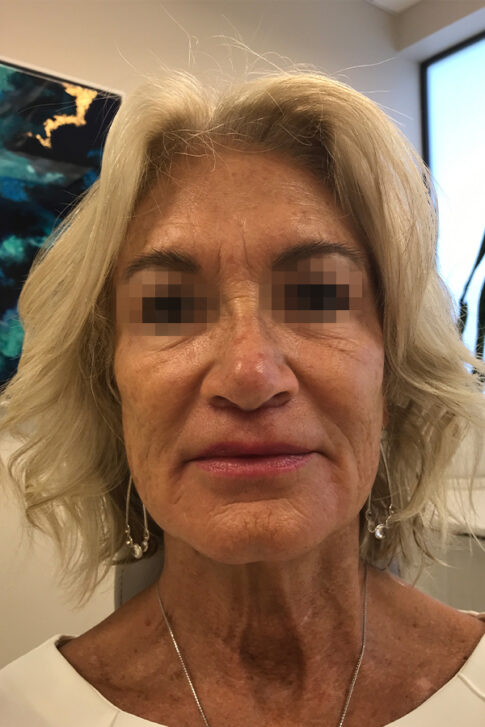 Case # 5 after photo