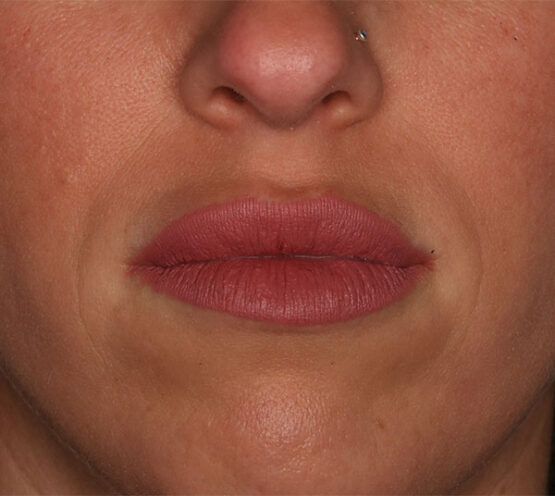 Case # 12 after photo