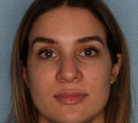 Case # 13 after photo