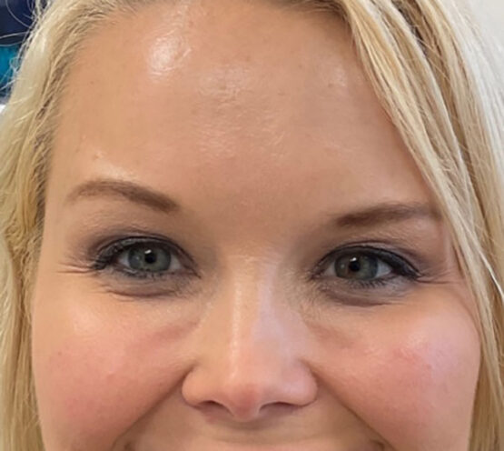 Case # 14 before photo