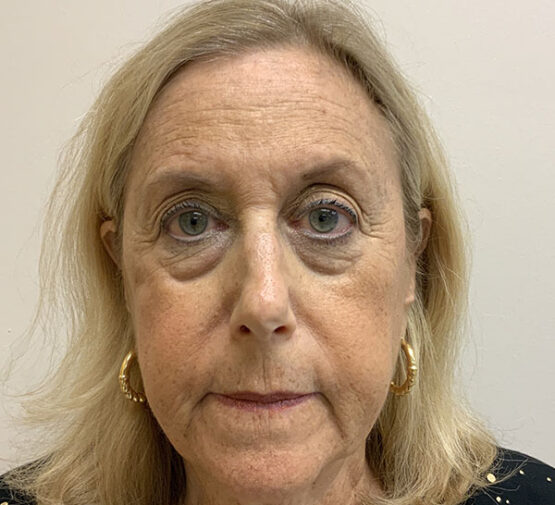 Case # 15 before photo