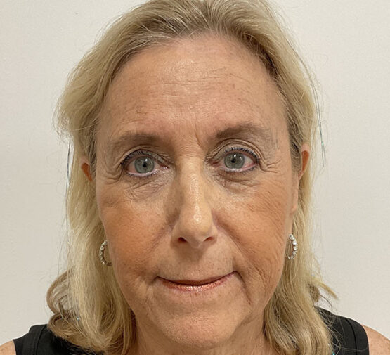 Case # 15 after photo