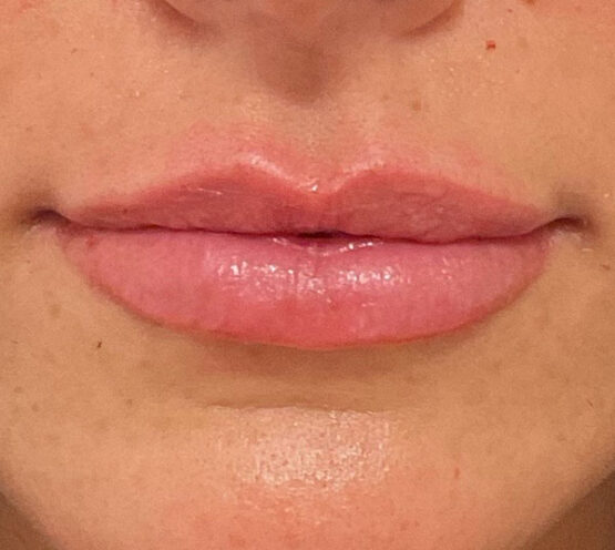 Case # 16 after photo