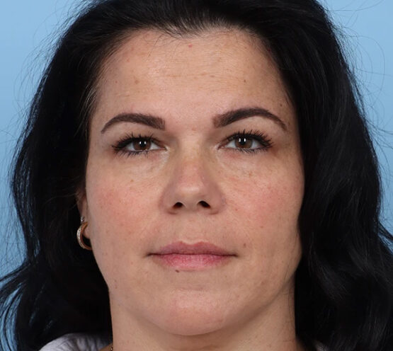 Case # 18 after photo