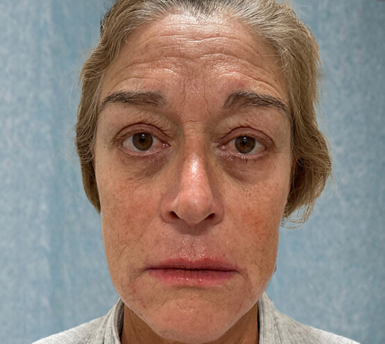 Case # 20 after photo