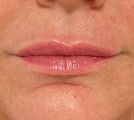 Case # 21 after photo