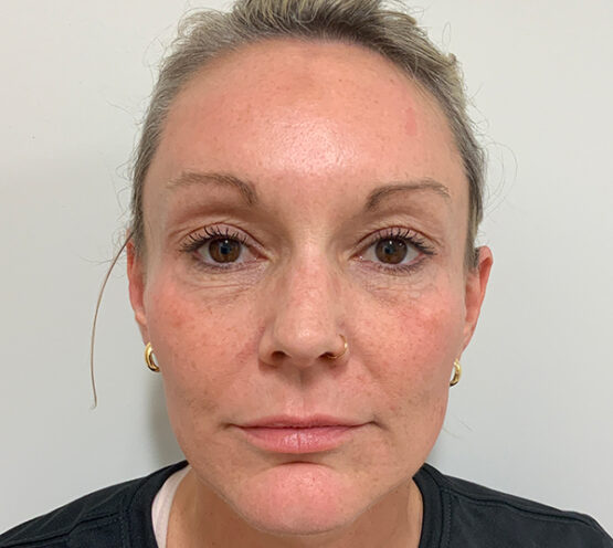 Case # 22 after photo