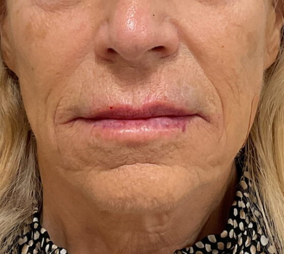 Case # 23 after photo