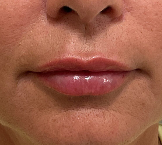 Case # 24 after photo