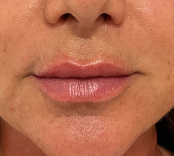 Case # 25 after photo