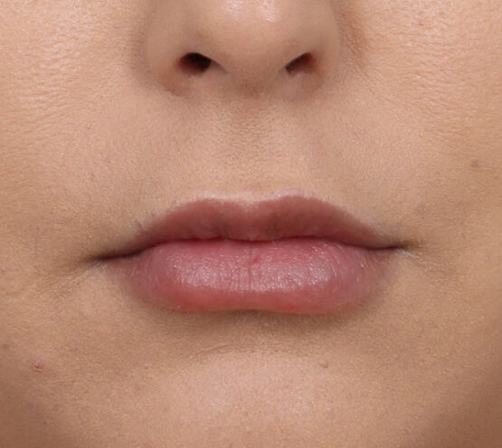 Case # 26 after photo