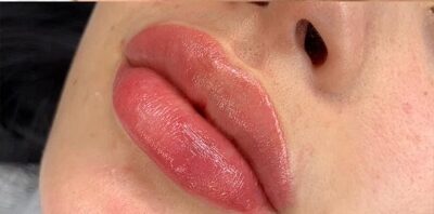 Case # 1 after photo