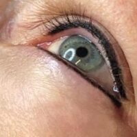 Case # 2 after photo