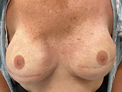 Case # 18 after photo